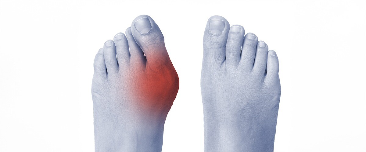 Hallux Valgus İçin En Doğru Çözüm: Forelli Ortopedik Ayakkabılar