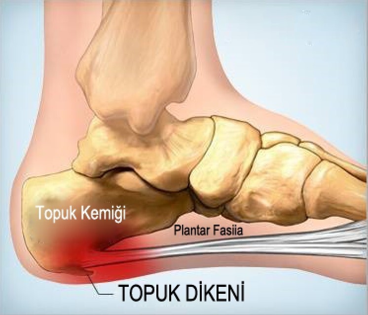 Topuk Dikeni Nedir? Belirtileri ve Günlük Yaşama Etkileri