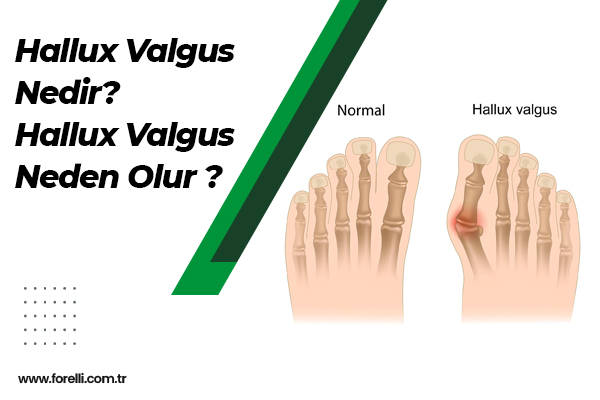 Hallux Valgus Nedir? Hallux Valgus Neden Olur ?