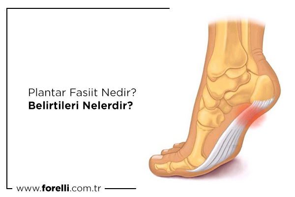 Plantar Fasiit Nedir? Belirtileri Nelerdir?